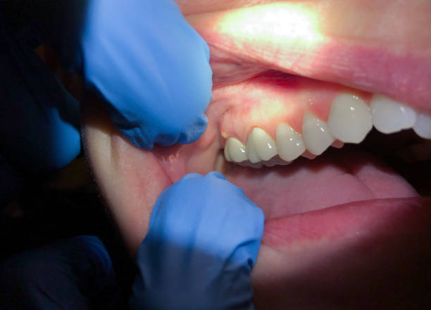 Best Emergency Dental Care for Broken or Chipped Teeth in Sea Ranch, CA