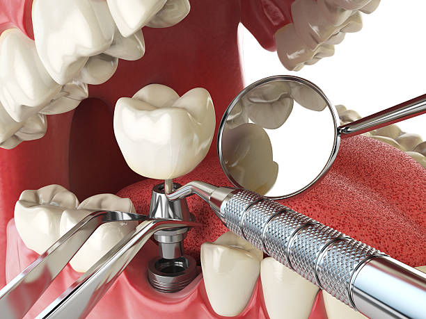Best Emergency Dental Care for Broken or Chipped Teeth in Sea Ranch, CA